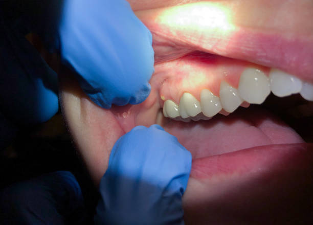 Emergency Dental Filling Replacement in FL